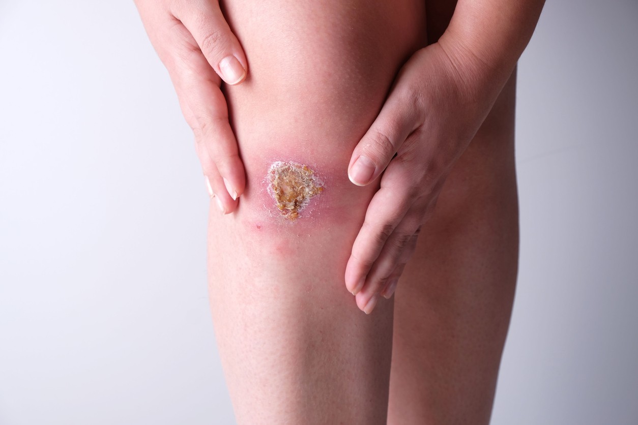 Αιτίες καθυστέρησης της επούλωσης των πληγών 